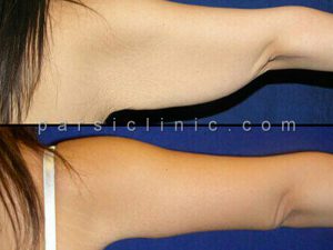 براکیوپلاستی جراحی زیبایی بازو