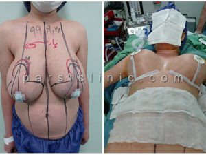 نمونه کار جراحی زیبایی کوچک کردن سینه و لیفت سینه - آذر 1399