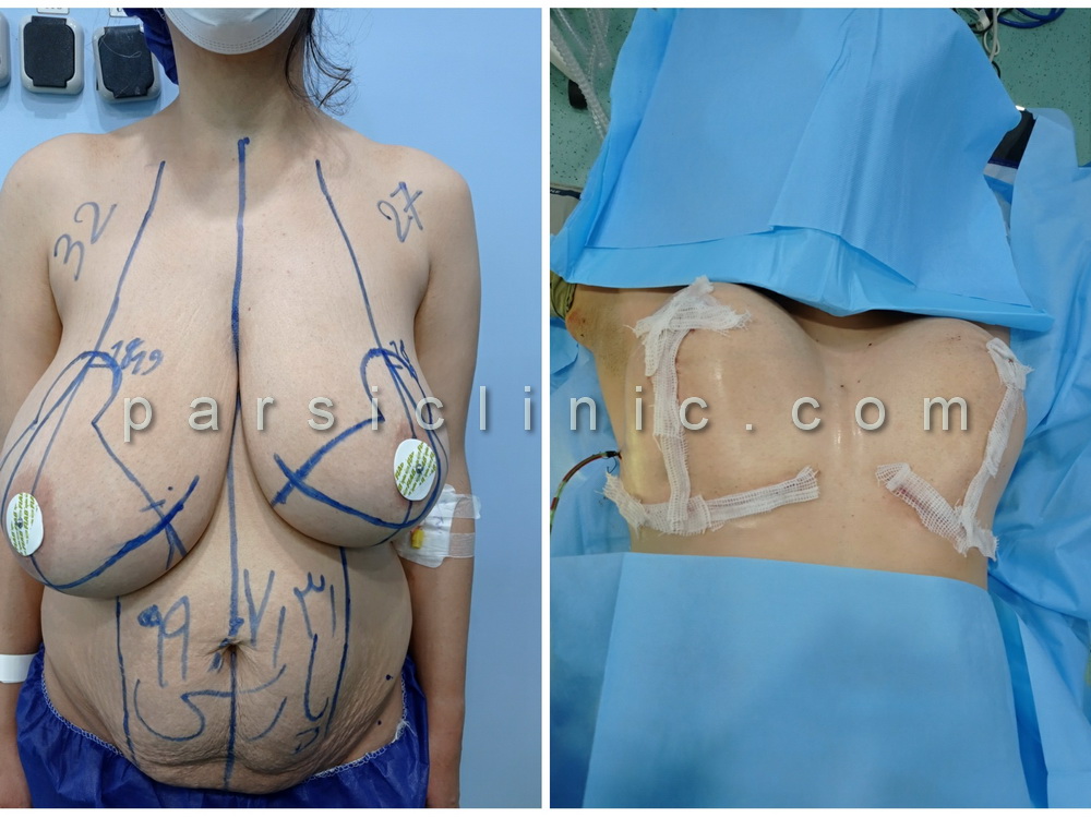 نمونه کار ماموپلاستی کاهشی و قرینه کردن سینه و ابدومینوپلاستی شکم - مهر 1399
