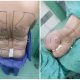 نمونه کار جراحی زیبایی لیپوماتیک پشت و پهلو و تزریق چربی و لیفت باسن - اردیبهشت 1400