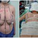 نمونه کار جراحی زیبایی کوچک کردن سینه و لیفت سینه - آذر 1399