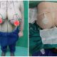 نمونه کار جراحی زیبایی سینه و ماموپلاستی کاهشی - اردیبهشت 1400