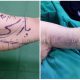 نمونه کار جراحی زیبایی لیفت بازو - آبان 1400