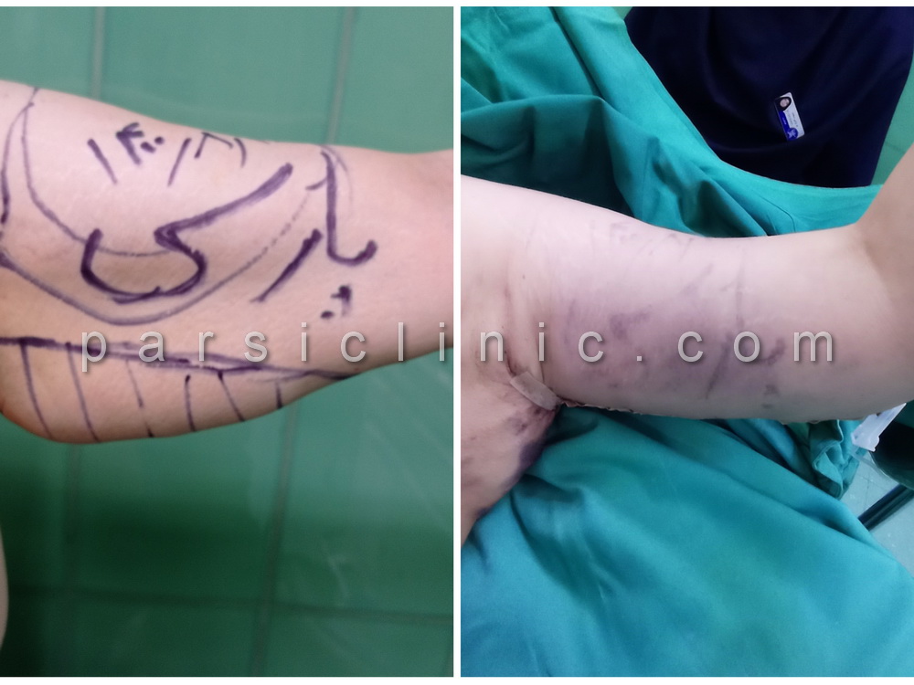 نمونه کار جراحی زیبایی لیفت بازو - آبان 1400