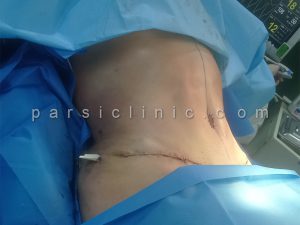 نمونه جراحی ابدومینوپلاستی و تزریق چربی به باسن آبان 1402 (2)